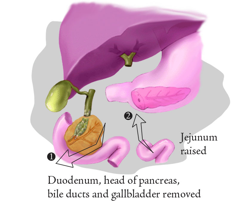 Pancreatic Resection